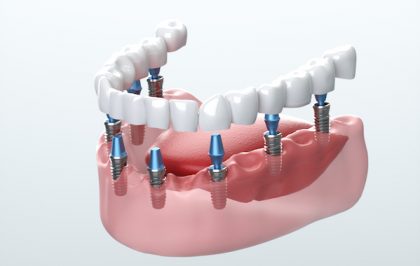 Встановлюємо коронки без болю: комфортне лікування в стоматологічній клініці Dentiplex