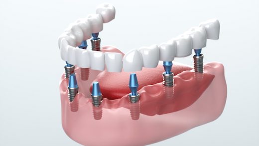 Встановлюємо коронки без болю: комфортне лікування в стоматологічній клініці Dentiplex